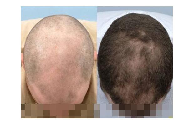 Gallery Before And After Photos Of Hair Loss Treatment Hair