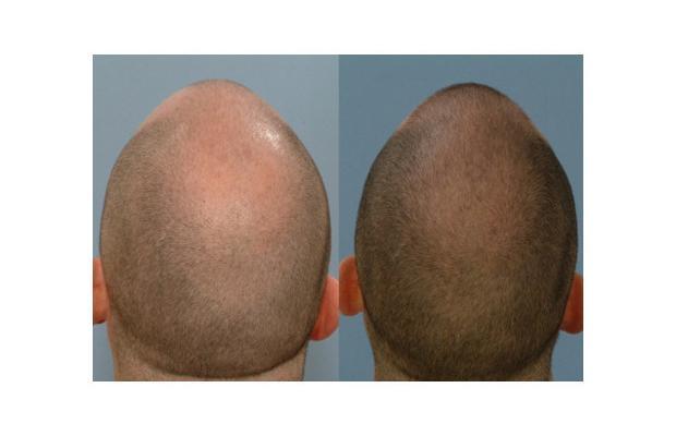 long term finasteride use