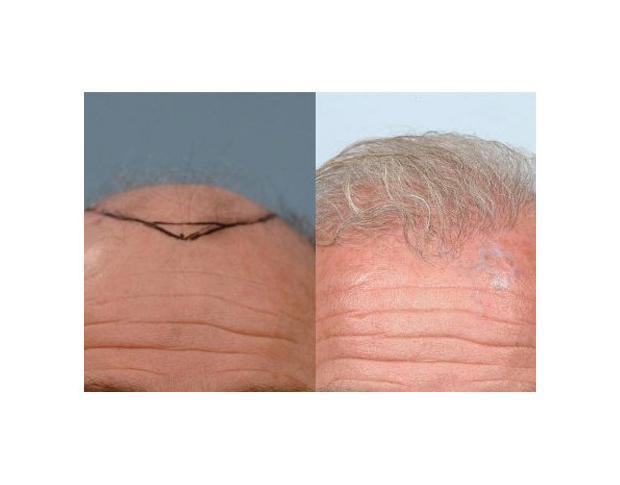 Bald Scalp Hair Transplant Before And After Photos