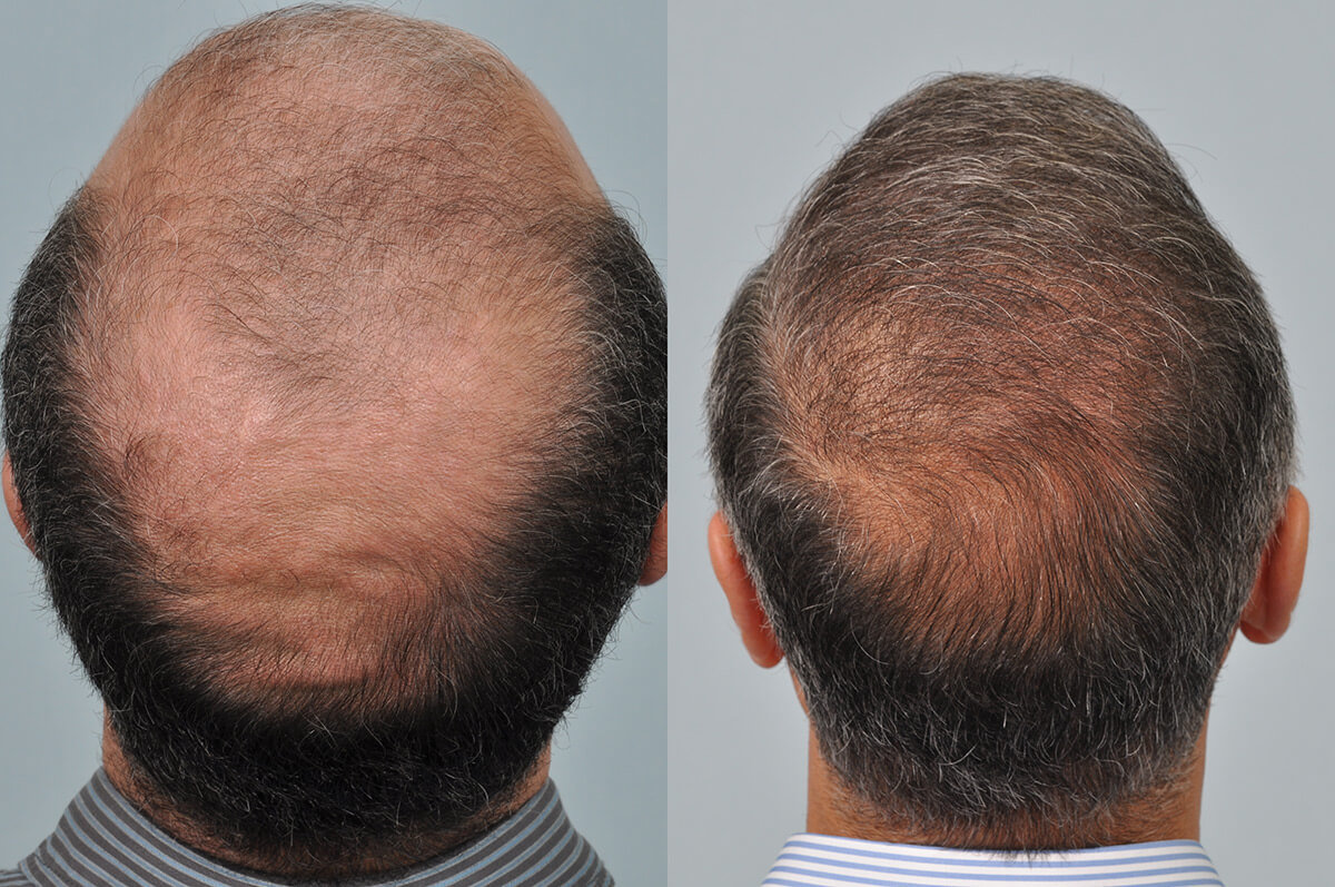 Hair Restoration Results At Hrbr A Case Study