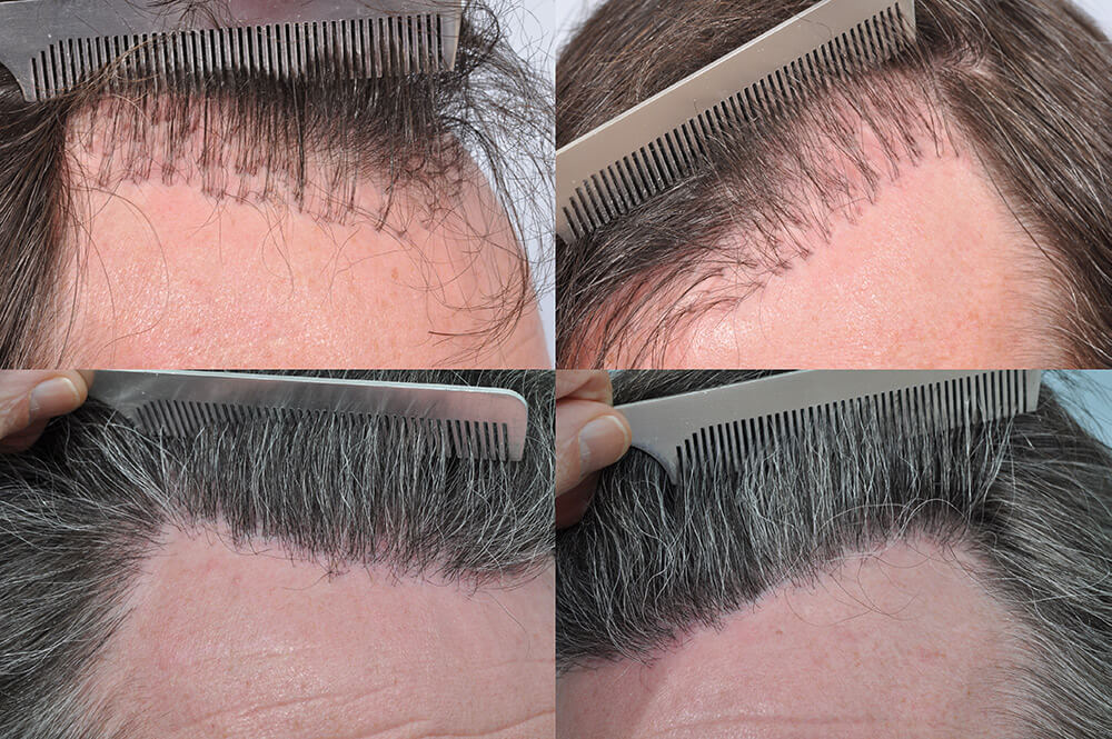 Discover More Than 72 Botched Hair Transplant Infection Super Hot In