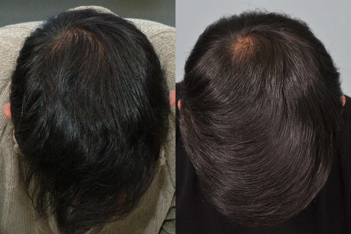 (Regaine) & Finasteride results after 10 years