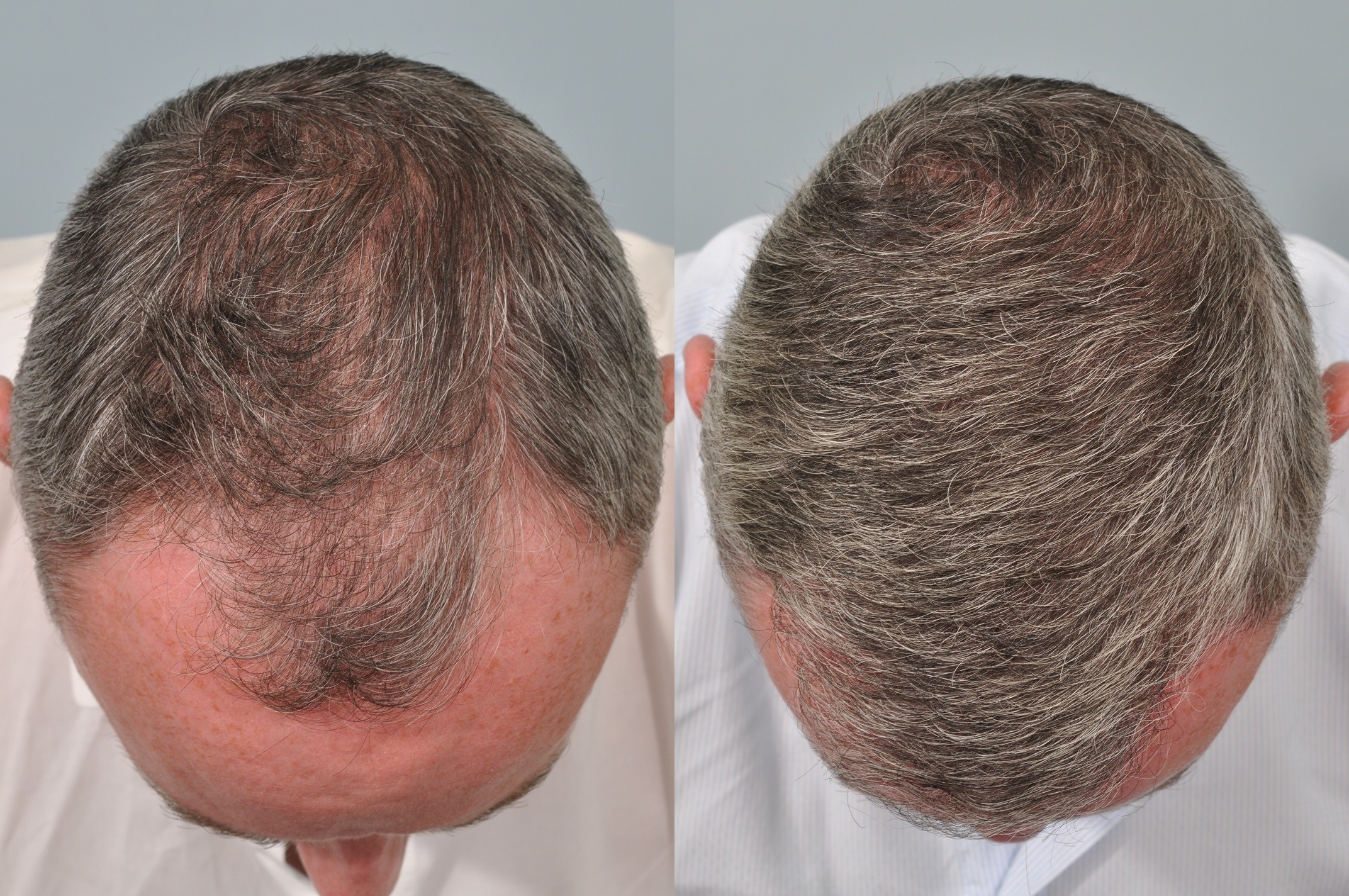 Hair Transplant After 2 Months Photos Results Side Effects