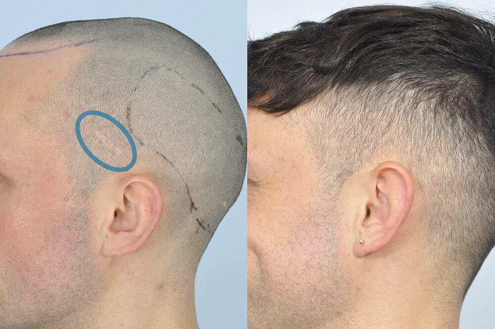 hair transplant scar