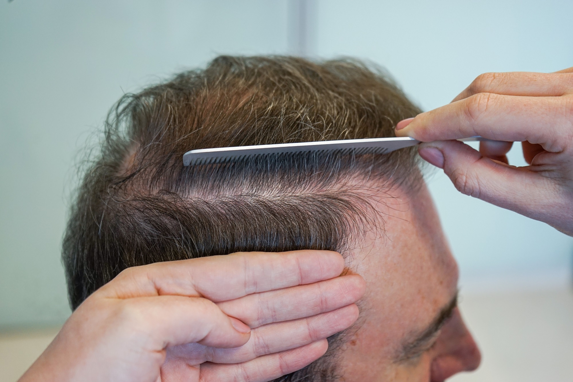 How long after a Hair Transplant are Grafts Secure? - Hair Transplant Clinic Ireland