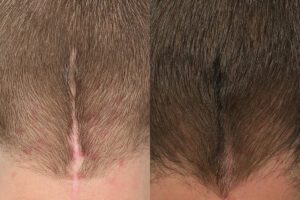 Treatment of scars before and after