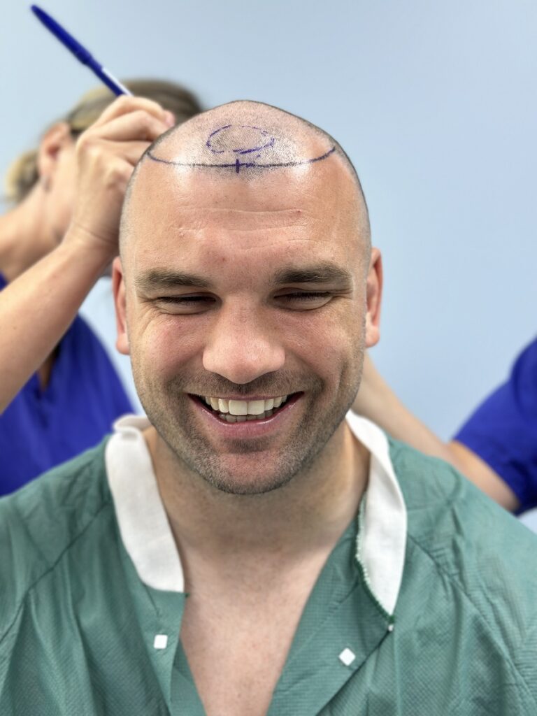 Tadhg Beirne Hair Transplant at HRBR